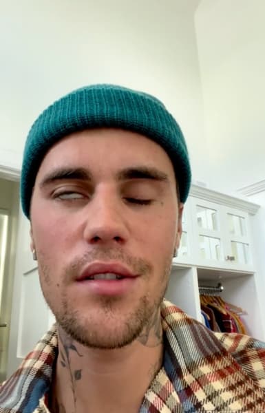 Justin Bieber's Face Is Paralyzed 